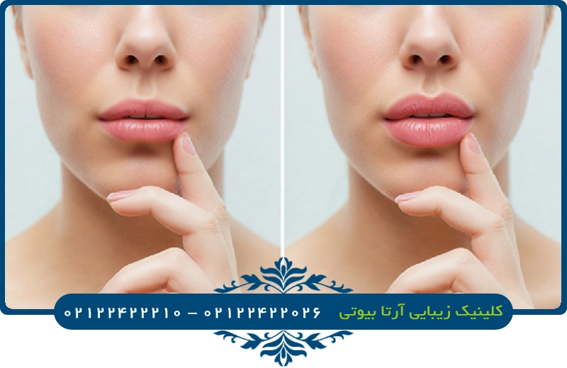 تزریق ژل لب مدل قلبی چیست؟