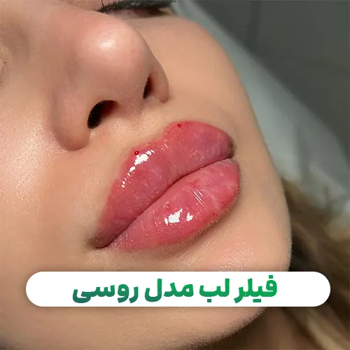 تزریق ژل لب مدل قلوه ای چیست؟ بررسی کامل عوارض و شرایط آن تزریق ژل لب مدل قلوه ای چیست؟ بررسی کامل عوارض و شرایط آن