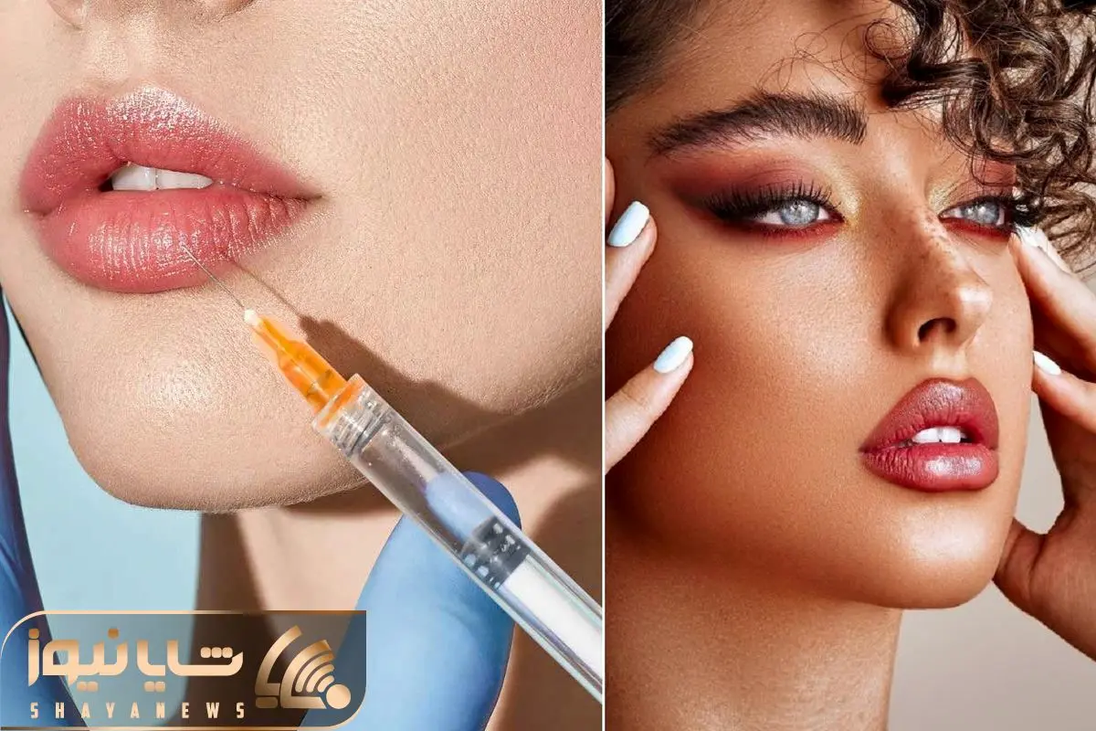 تزریق ژل لب مدل قلوه ای چیست؟ بررسی کامل عوارض و شرایط آن تزریق ژل لب مدل قلوه ای چیست؟ بررسی کامل عوارض و شرایط آن