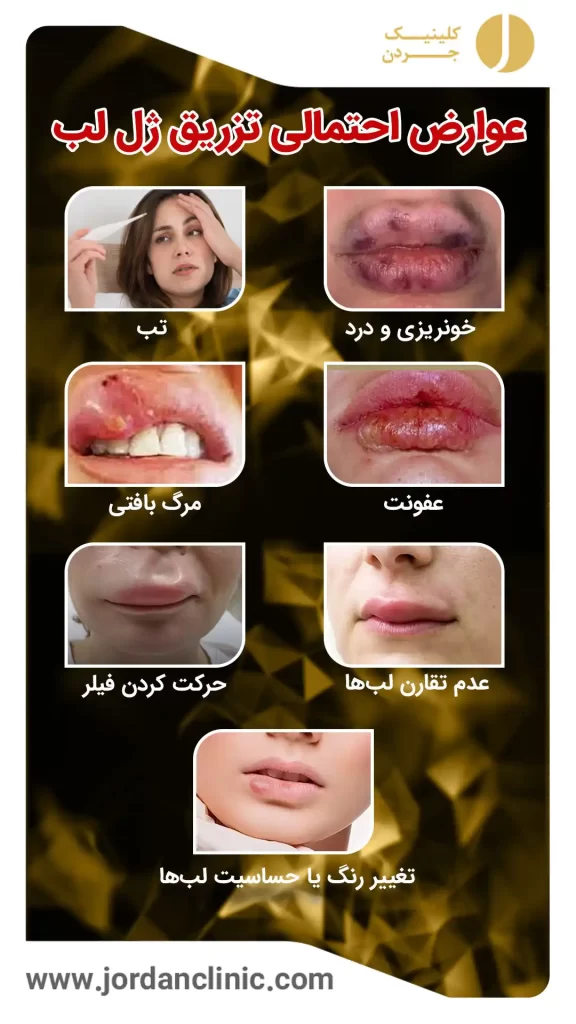 تزریق ژل لب مدل نچرال به چه صورت؟ | دکتر حمیدرضا بهمنی تزریق ژل لب مدل نچرال به چه صورت؟ | دکتر حمیدرضا بهمنی