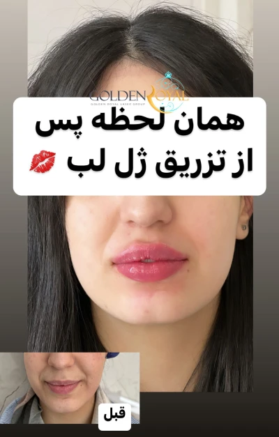 تزریق ژل لب مدل گرد ❤️ + فیلم و عکس ✔️ | مرکز زیبایی و لیزر تزریق ژل لب مدل گرد ❤️ + فیلم و عکس ✔️ | مرکز زیبایی و لیزر