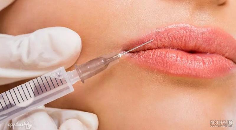 تزریق ژل لب چاک دار و هر آنچه بایستی در این مورد بدانید - کلینیک دلتا