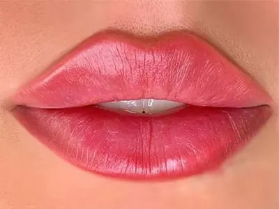 تزریق ژل مدل قلبی؛ فرم دهی لب با نتایج طبیعی - کلینیک هلیا