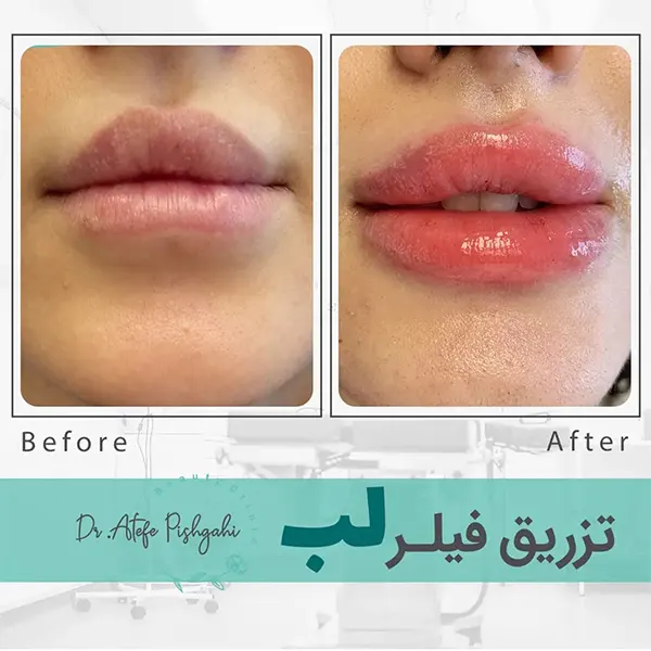 تصاویر قبل و بعد از تزریق ژل تصاویر قبل و بعد از تزریق ژل