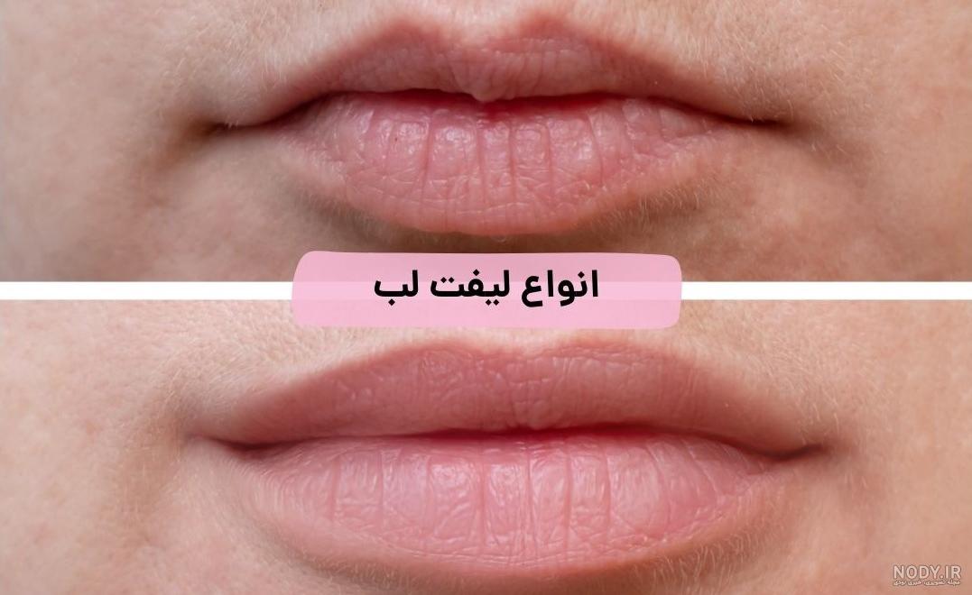 تصاویر لیفت لب - تصاویر قبل و بعد از لیفت سانترالب لب تصاویر لیفت لب - تصاویر قبل و بعد از لیفت سانترالب لب