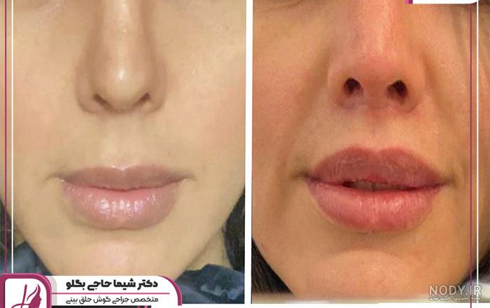 تصاویر لیفت لب - تصاویر قبل و بعد از لیفت سانترالب لب تصاویر لیفت لب - تصاویر قبل و بعد از لیفت سانترالب لب