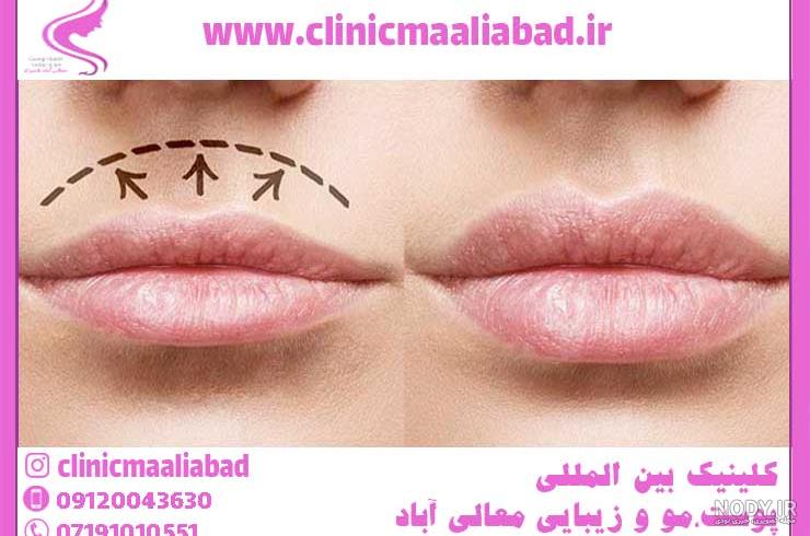 تصاویر لیفت لب - تصاویر قبل و بعد از لیفت سانترالب لب تصاویر لیفت لب - تصاویر قبل و بعد از لیفت سانترالب لب