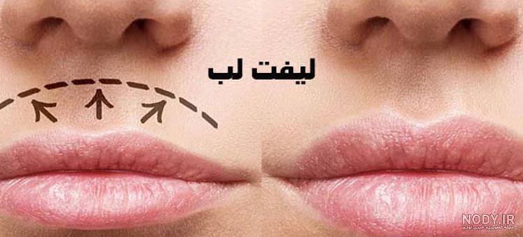 جراحی سانترال لب (لیفت لب) راز جذابیت لب + عکس قبل و بعد - دکتر سارا بهروان جراحی سانترال لب (لیفت لب) راز جذابیت لب + عکس قبل و بعد - دکتر سارا بهروان