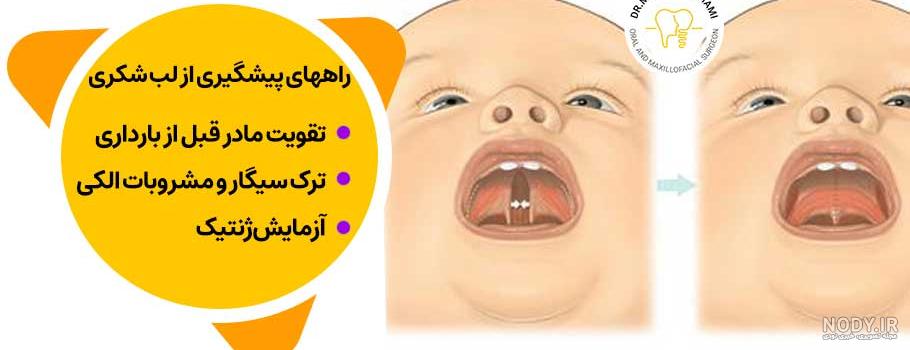 جراحی لب شکری و شکاف کام - دکتر هادی سرمست جراحی لب شکری و شکاف کام - دکتر هادی سرمست