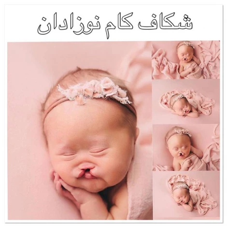 جراحی لب شکری و شکاف کام - دکتر هادی سرمست