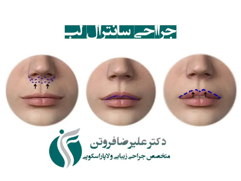 جراحی لیفت سانترال و بالا کشیدن لب - دکتر افسانه ثنایی جراحی لیفت سانترال و بالا کشیدن لب - دکتر افسانه ثنایی