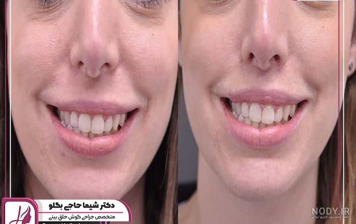 جراحی لیفت سانترال لب چیست و با چه روش‌هایی انجام می شود؟