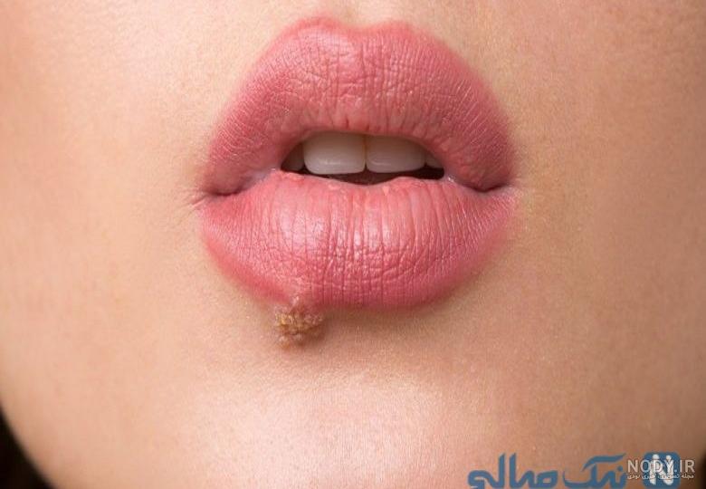 جوش دور لب و دهان به چه علت است و چگونه قابل درمان و پیشگیری است؟ | زیمالب جوش دور لب و دهان به چه علت است و چگونه قابل درمان و پیشگیری است؟ | زیمالب