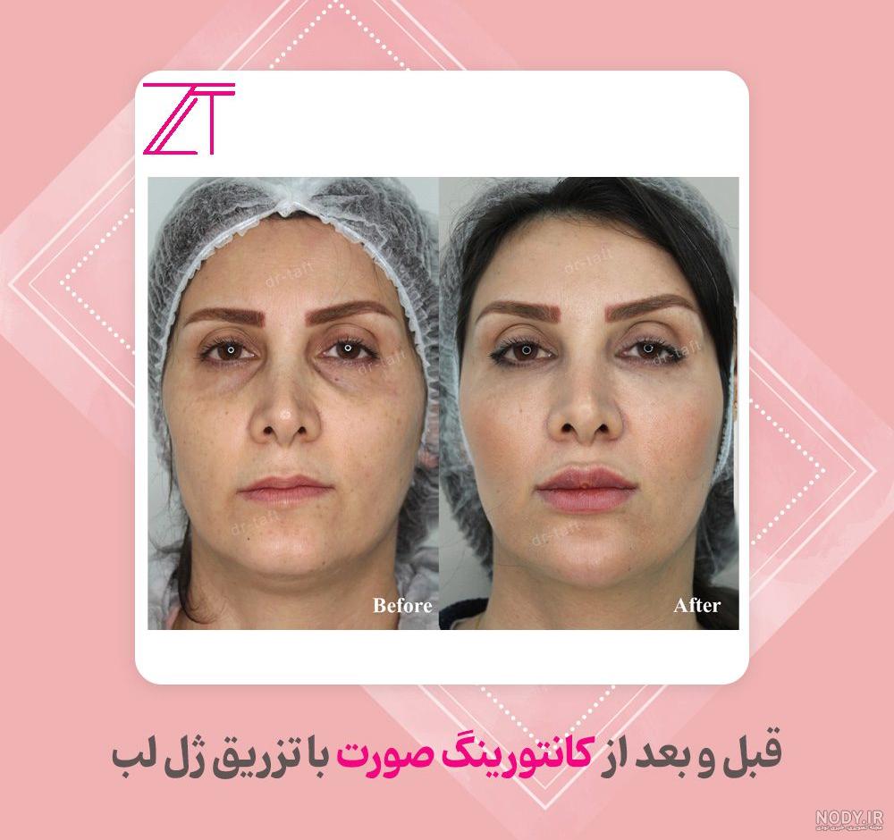 دختری که بزرگ‌ترین لب‌های دنیا را دارد! /عکس | روزنو