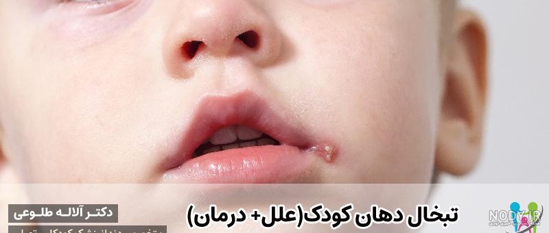 درمان ترک لب نوزاد و شایع ترین علل ترک خوردن لب نوزاد | نی نی پلاس درمان ترک لب نوزاد و شایع ترین علل ترک خوردن لب نوزاد | نی نی پلاس