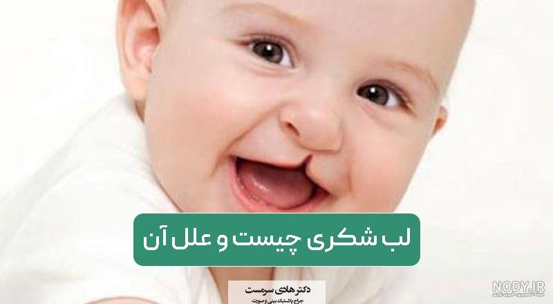 درمان لب شکری یا شکاف کام و لب - دکتر فرزین اصلانی متخصص ارتودنسی در کرج و  تهران