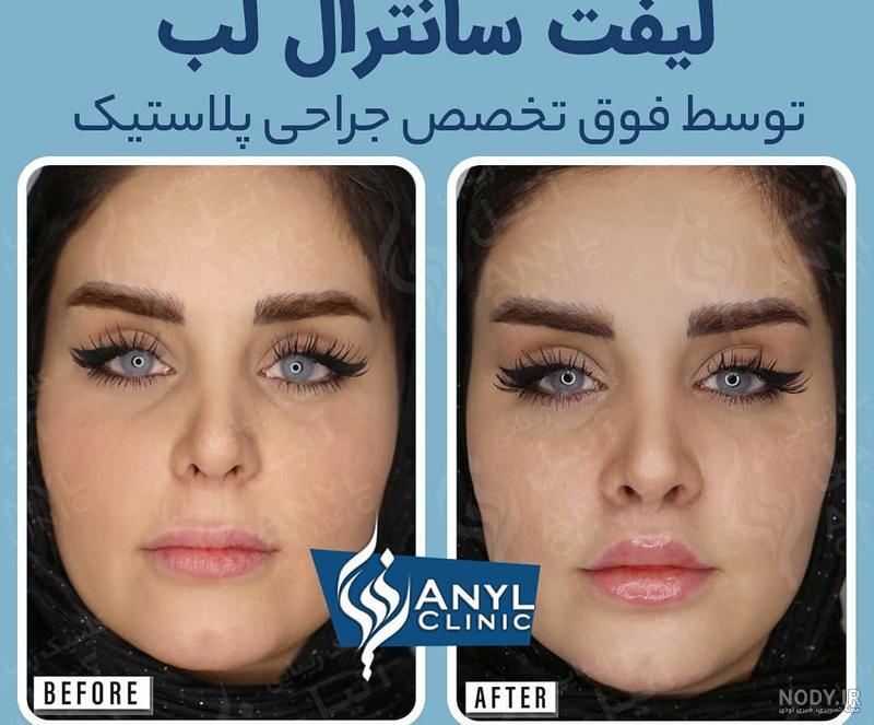 سانترال لب | لیفت سانترال لب| جراحی سانترال لب | هزینه سانترال لب- دکتر علرضا فروتن سانترال لب | لیفت سانترال لب| جراحی سانترال لب | هزینه سانترال لب- دکتر علرضا فروتن