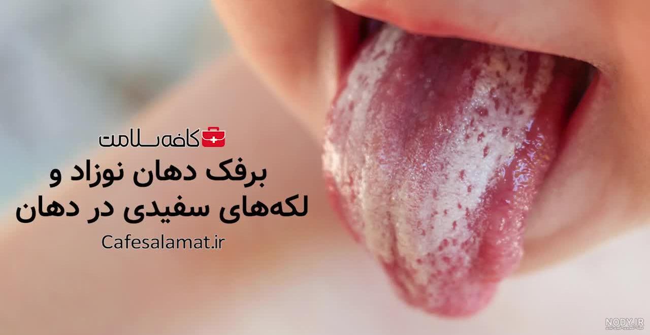 سفید شدن زبان نوزاد : برفک دهان - دیگر علت ها - علائم - درمان - پیشگیری |  باقیمانده شیر
