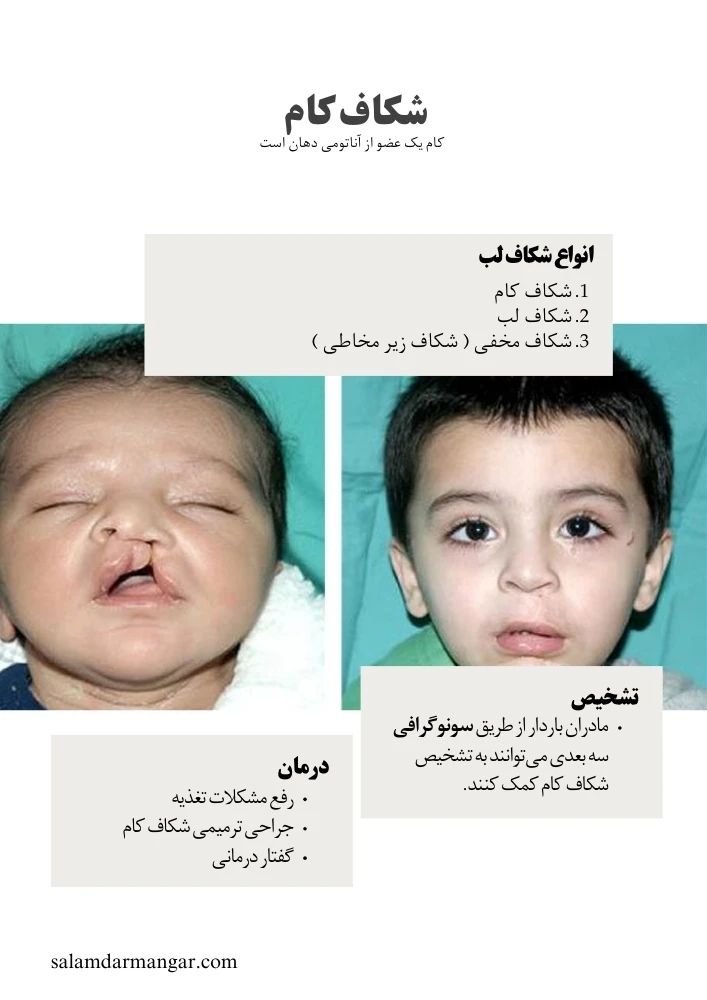 شکاف کام و لب شکری چیست؟ – دکتر فاضل فیروزی | ارتودنسی | درمان ارتودنسی | کلینیک ارتودنسی شکاف کام و لب شکری چیست؟ – دکتر فاضل فیروزی | ارتودنسی | درمان ارتودنسی | کلینیک ارتودنسی