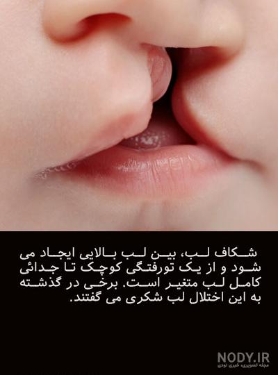 شکاف کام، لب چبست؟ علت، علائم، تشخیص، پیشگیری، درمان موثر