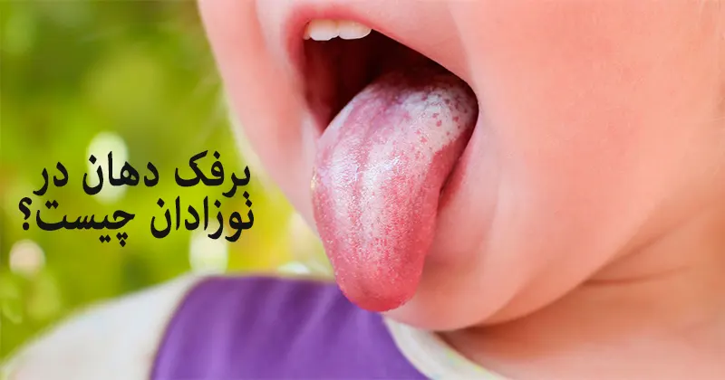 علائم برفک دهان نوزاد،تشخیص،عکس+درمان برفک دهان کودک