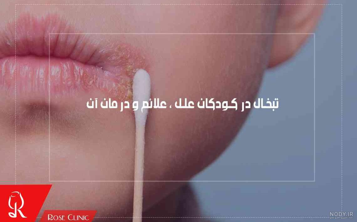 علت تبخال دهانی کودک چیست؟ علت تبخال دهانی کودک چیست؟