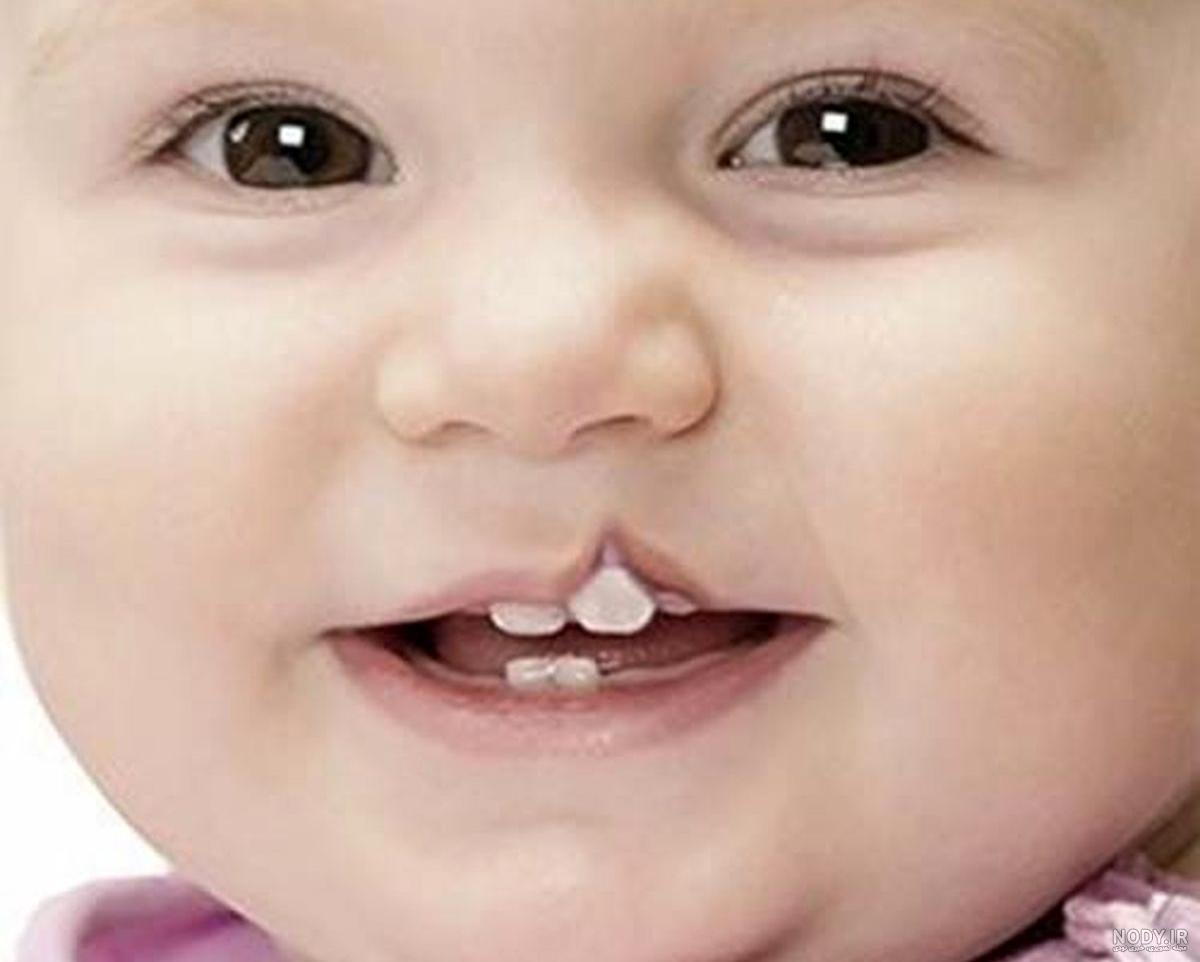 عکس از نوزادان لب شکری
