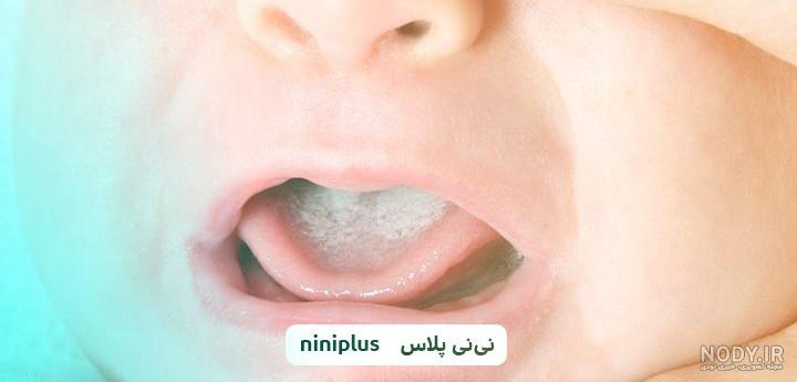 عکس برفک دهان نوزاد نی نی سایت - عکس نودی