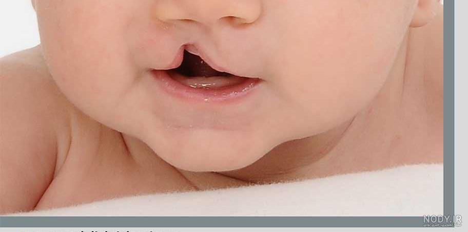 عکس بچه های لب شکری
