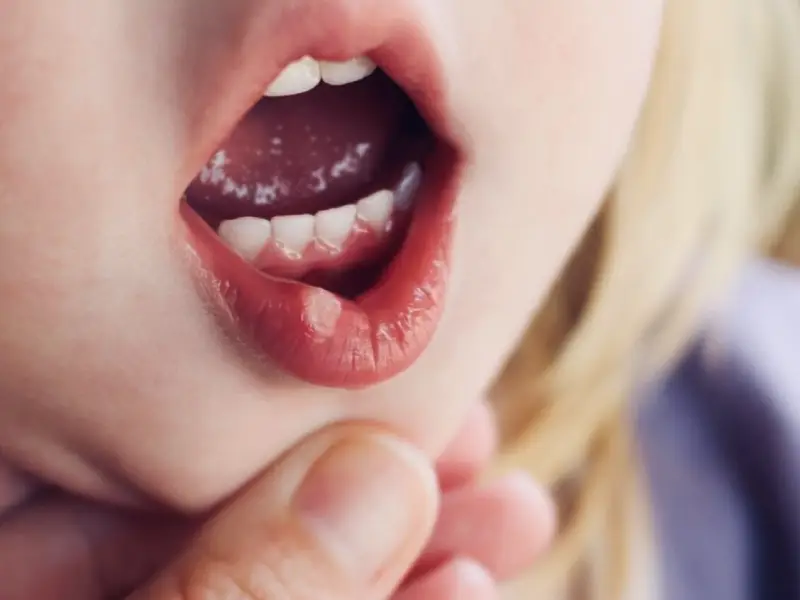 عکس تاول لب نوزاد عکس تاول لب نوزاد