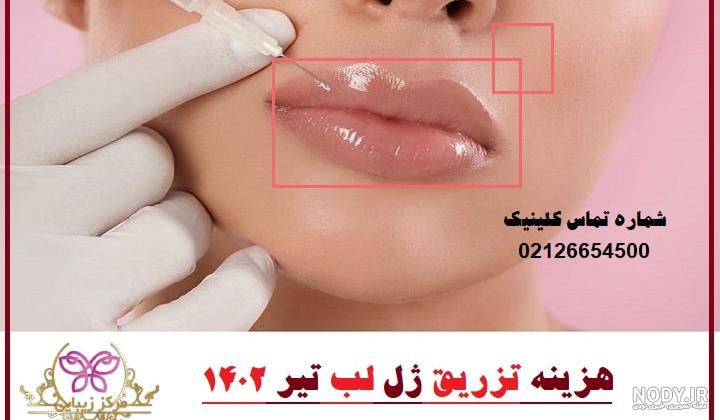عکس تزریق ژل لب - 10 نکته مهم در تزریق ژل لب - گلوریا سنتر