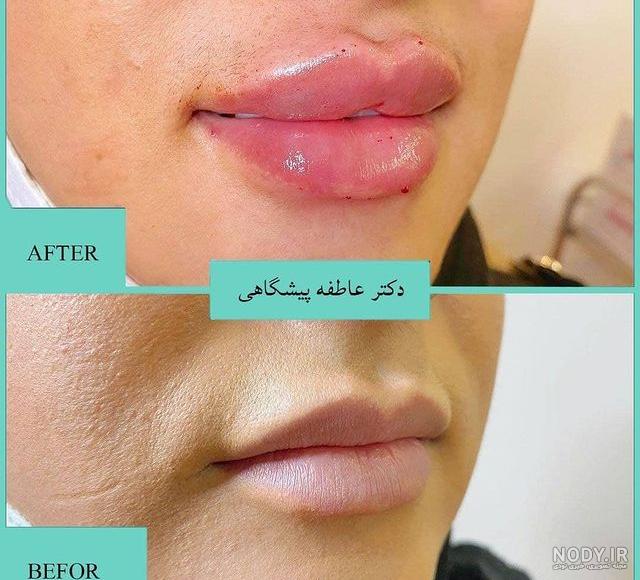 عکس تزریق ژل لب - 10 نکته مهم در تزریق ژل لب - گلوریا سنتر