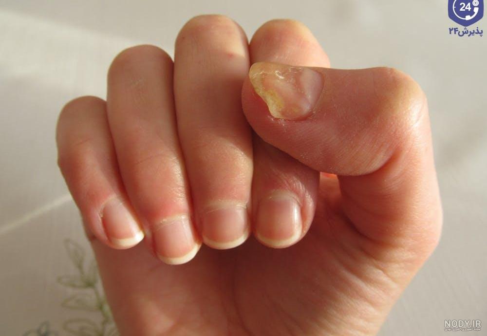 عکس قارچ گرفتن ناخن عکس قارچ گرفتن ناخن