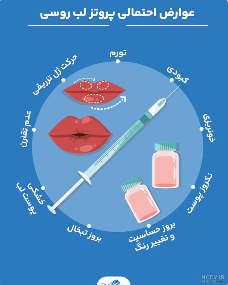 عکس قبل و بعد از مدل تزریق ژل لب روسی ✔️کِلینیک42 عکس قبل و بعد از مدل تزریق ژل لب روسی ✔️کِلینیک42