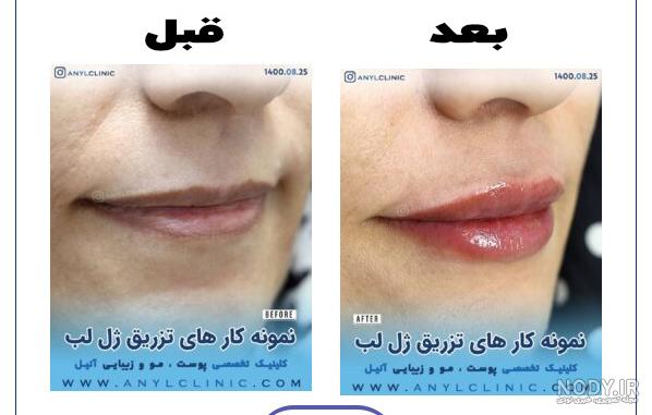 عکس قبل و بعد از مدل تزریق ژل لب روسی ✔️کِلینیک42 عکس قبل و بعد از مدل تزریق ژل لب روسی ✔️کِلینیک42