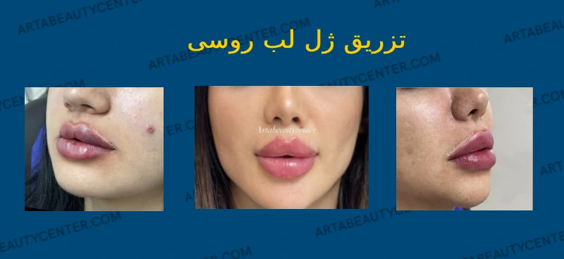 عکس قبل و بعد تزریق ژل خط خنده - مرکز زیبایی الیزه بهترین مرکز لیزر عکس قبل و بعد تزریق ژل خط خنده - مرکز زیبایی الیزه بهترین مرکز لیزر