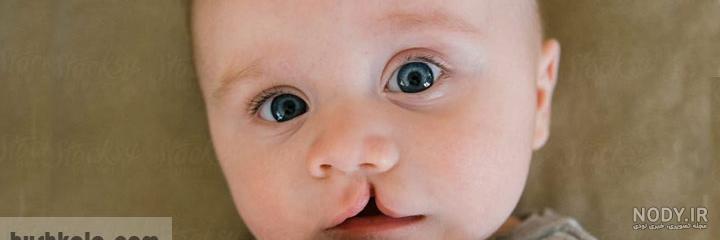 عکس لب شکری ها