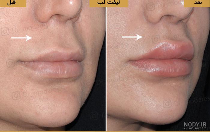 عکس لب لیفت شده عکس لب لیفت شده