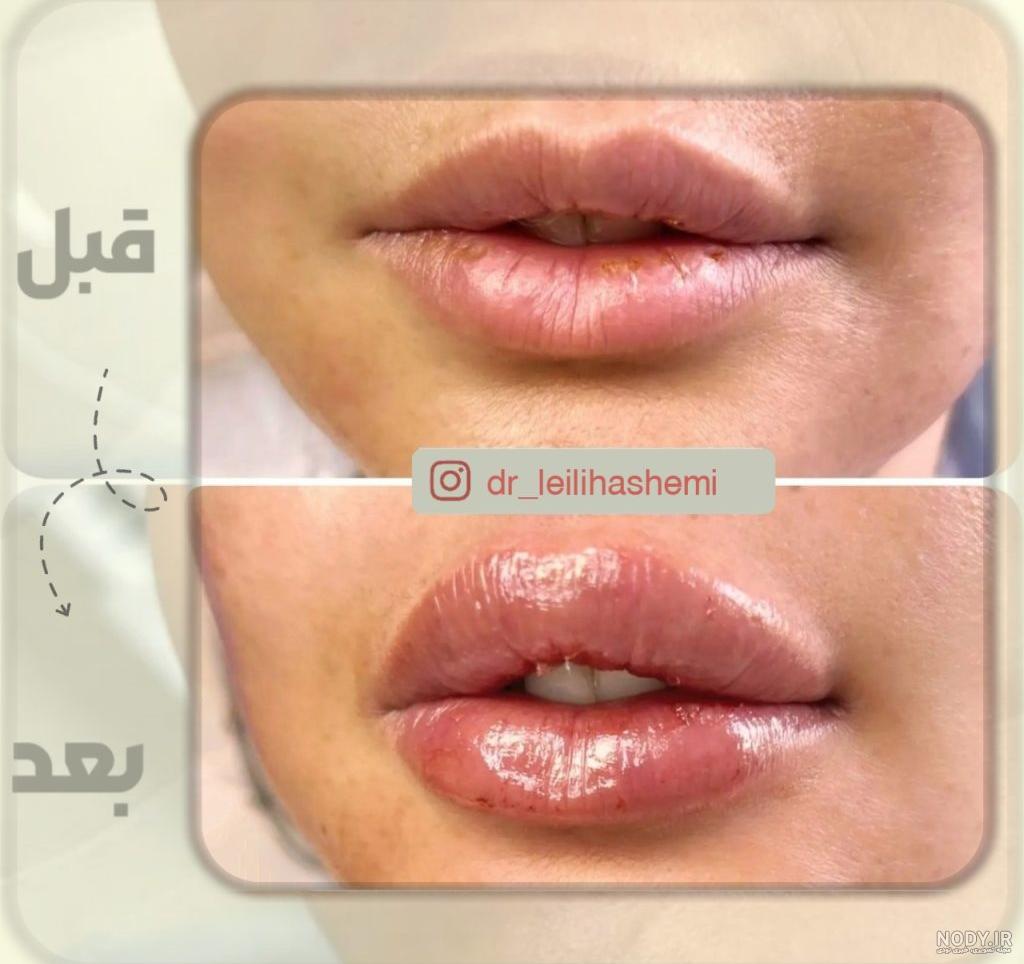 عکس لب پروتز کرده عکس لب پروتز کرده