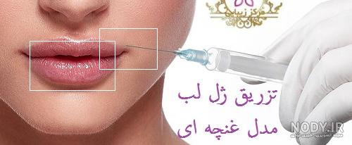 عکس لب ژل زده ۱۴۰۰ - عکس نودی