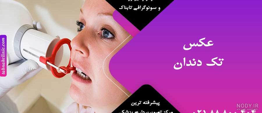 عکس لمینت دندان و کامپوزیت دندان 1 - دندانپزشکی دکتر منوچهر هاشمی عکس لمینت دندان و کامپوزیت دندان 1 - دندانپزشکی دکتر منوچهر هاشمی