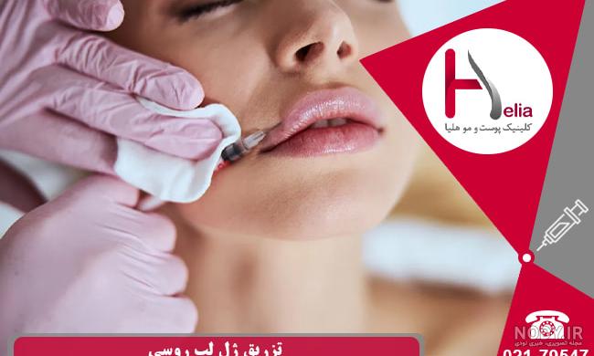 عکس لیفت لب روسی عکس لیفت لب روسی