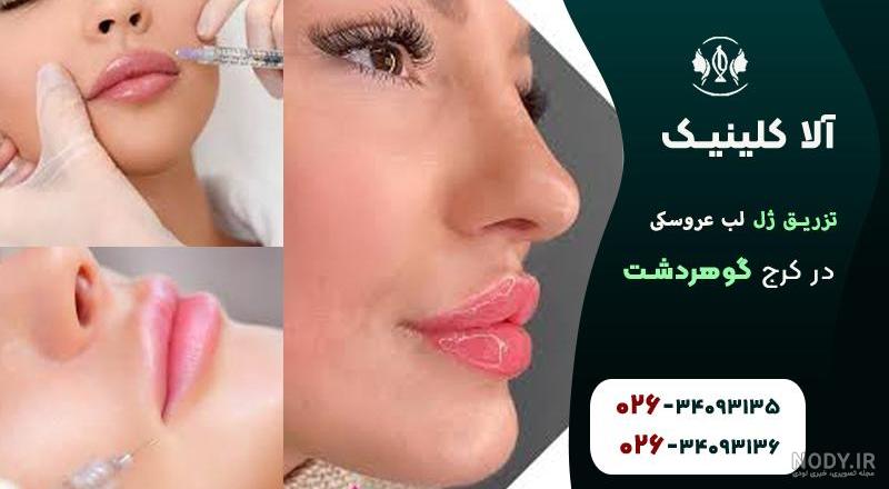 عکس ژل لب عروسکی