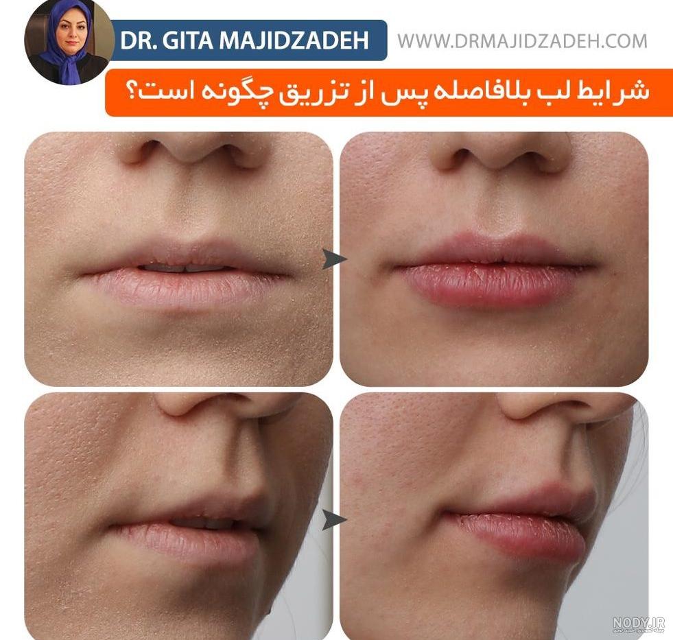عکس ژل لب فرانسوی عکس ژل لب فرانسوی