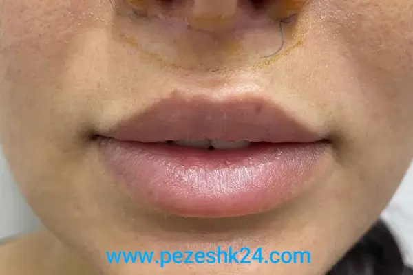 فرمدهی دائمی لب با سانترال لب | هزینه سانترال لب | دکتر خوب برای لیفت سانترال لب فرمدهی دائمی لب با سانترال لب | هزینه سانترال لب | دکتر خوب برای لیفت سانترال لب