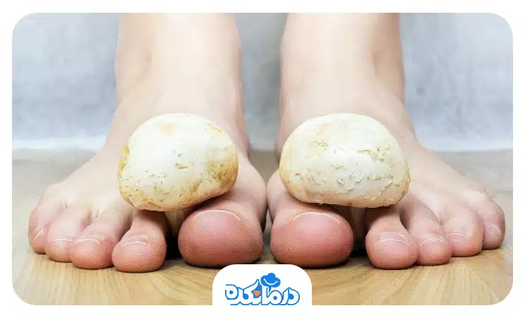 قارچ عکس هوا گرفتن ناخن قارچ عکس هوا گرفتن ناخن