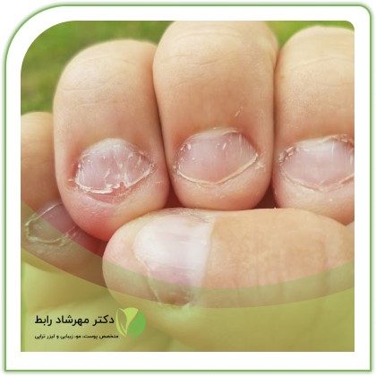 قارچ ناخن چیست+ راهکار درمان قارچ ناخن | روژا شاپ قارچ ناخن چیست+ راهکار درمان قارچ ناخن | روژا شاپ