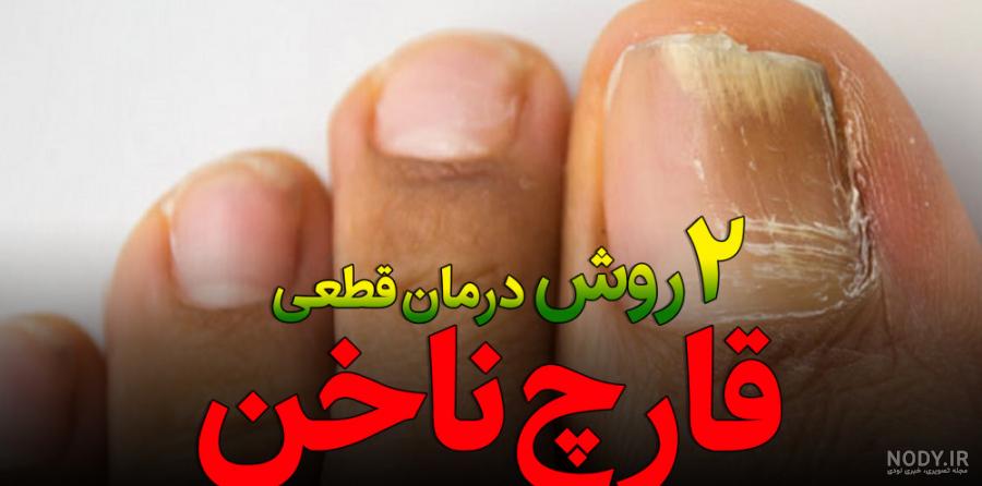 قارچ ناخن چیست؛ علائم و راه های درمان قارچ ناخن قارچ ناخن چیست؛ علائم و راه های درمان قارچ ناخن