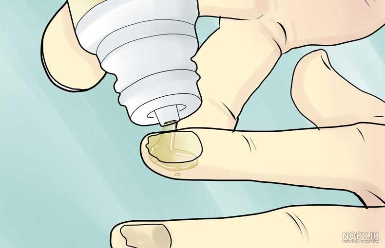 قارچ ناخن چیست؟ این بیماری چه علائمی داشته و چگونه درمان میشود؟ قارچ ناخن چیست؟ این بیماری چه علائمی داشته و چگونه درمان میشود؟