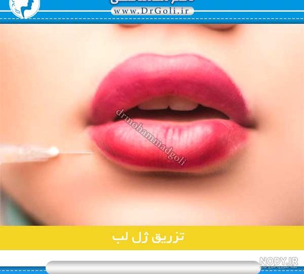 قیمت انواع ژل لب و گونه | هزینه تزریق ژل لب و گونه | دکتر گیتا مجیدزاده قیمت انواع ژل لب و گونه | هزینه تزریق ژل لب و گونه | دکتر گیتا مجیدزاده